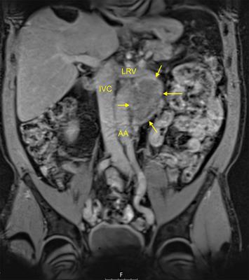 Serum Levels of MicroRNA-371a-3p (M371) Can Predict Absence or Presence of Vital Disease in Residual Masses After Chemotherapy of Metastatic Seminoma